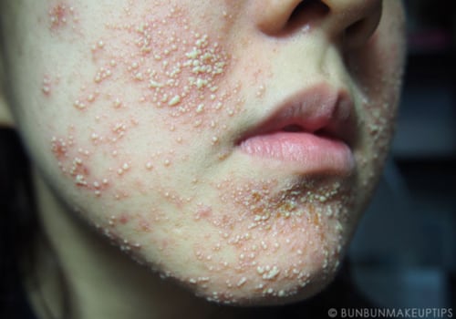 Is facial good for skin or not?