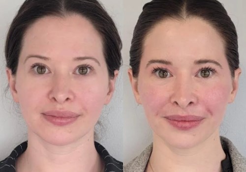 Refresh Your Look with Botox at Cheeky Denver